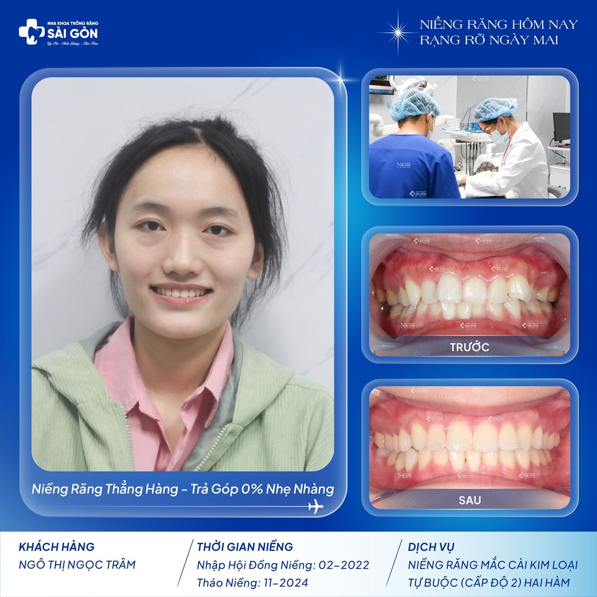 ngo thi ngoc tram nieng rang tai nha khoa trong rang sai gon Bạn Ngô Thị Ngọc Trâm niềng răng mắc cài kim loại tự buộc (cấp độ 2) hai hàm tại Nha Khoa Trồng Răng Sài Gòn