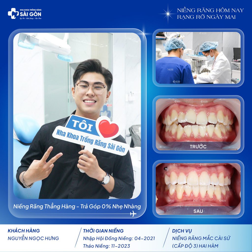 Nguyễn Ngọc Hưng niềng răng mắc cài sứ (cấp độ 3)