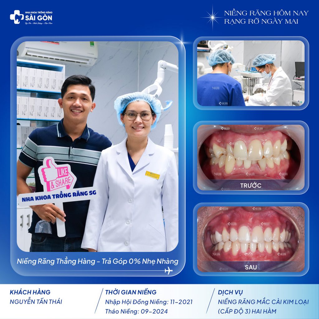 Nguyễn Tấn Thái niềng răng mắc cài kim loại (cấp độ 3) tại Nha Khoa Trồng Răng Sài Gòn