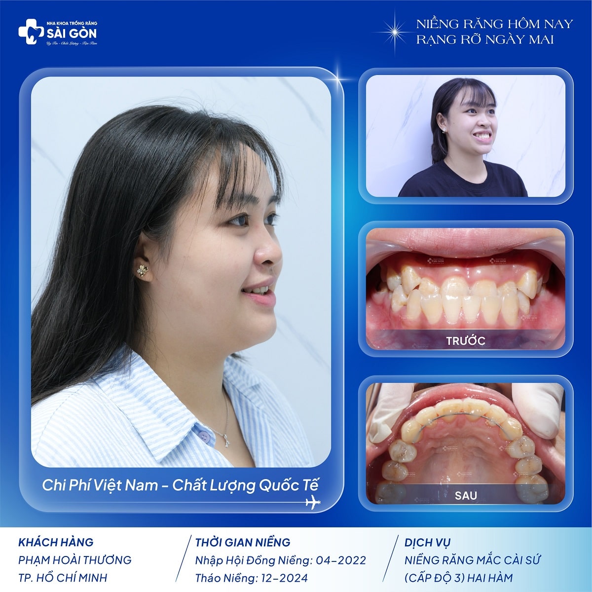 pham hoai thuong nieng rang mac cai su cap do 3 hai ham Phạm Hoài Thương niềng răng mắc cài sứ cấp độ 3 hai hàm tại Nha Khoa Trồng Răng Sài Gòn