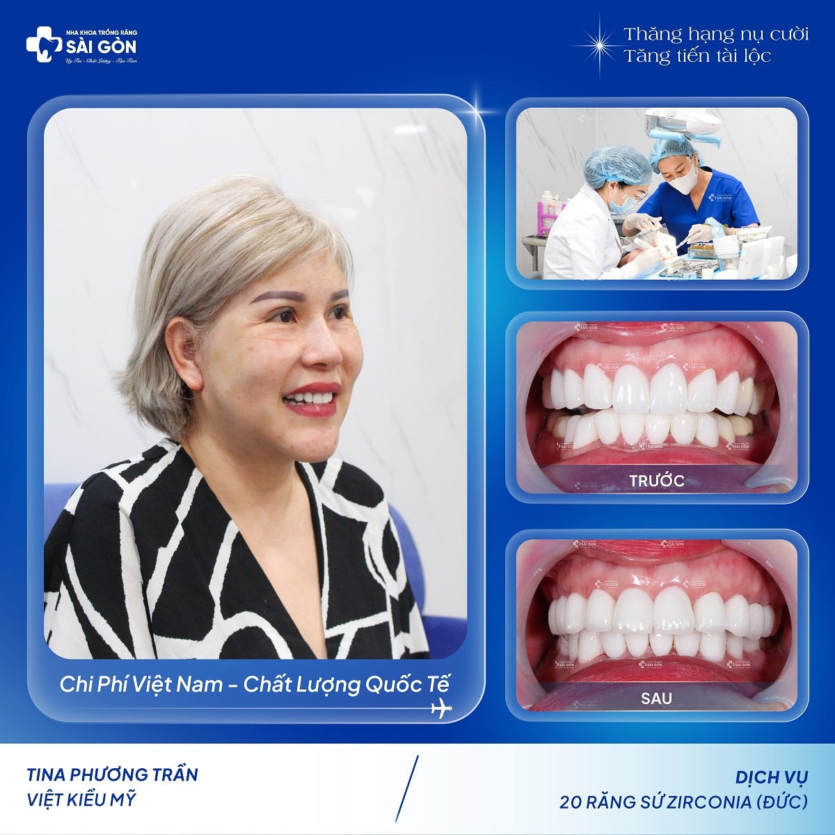 Tina Phương Trần Việt Kiều Mỹ Bọc 20 Răng Sứ Zirconia tại Nha Khoa Trồng Răng Sài Gòn