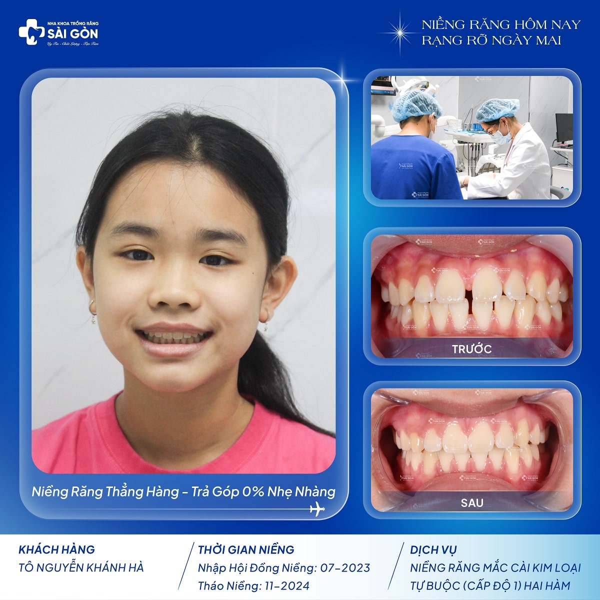 to nguyen khanh ha nieng rang tai nha khoa trong rang sai gon Bạn Tô Nguyễn Khánh Hà niềng răng mắc cài kim loại tự buộc (cấp độ 1) hai hàm tại Nha Khoa Trồng Răng Sài Gòn
