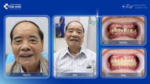 Bác Trần Kim Định Trồng Răng Implant Ở Tuổi 90 Tại Nha Khoa Trồng Răng Sài Gòn
