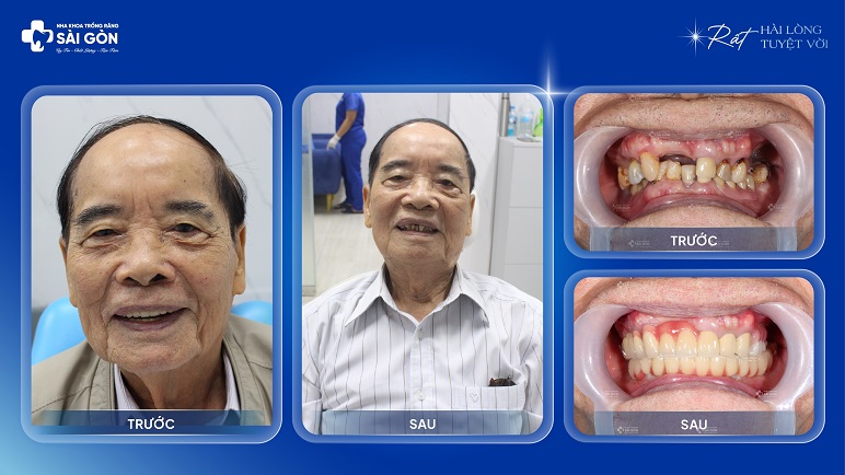 Bác Trần Kim Định Trồng Răng Implant Ở Tuổi 90 Tại Nha Khoa Trồng Răng Sài Gòn