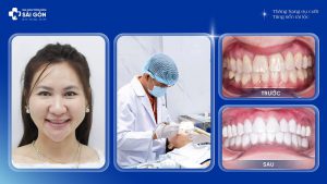 Chị Hân Phạm (Việt Kiều Canada) Dán Sứ Veneer Emax Hai Hàm Tại Nha Khoa Trồng Răng Sài Gòn