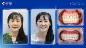 Chị Phạm Thị Hồng Loan Việt Kiều Nhật Trồng Răng Sứ Hai Hàm
