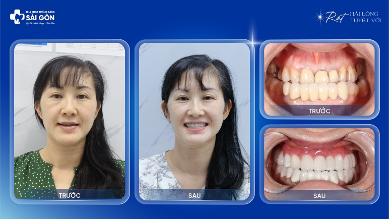 Chị Phạm Thị Hồng Loan Việt Kiều Nhật Trồng Răng Sứ Hai Hàm