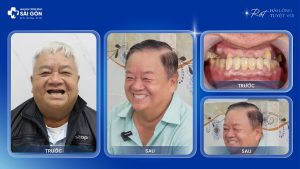 Chú Bùi Hoàn Thành trồng răng implant trẻ ra thêm nhiều tuổi