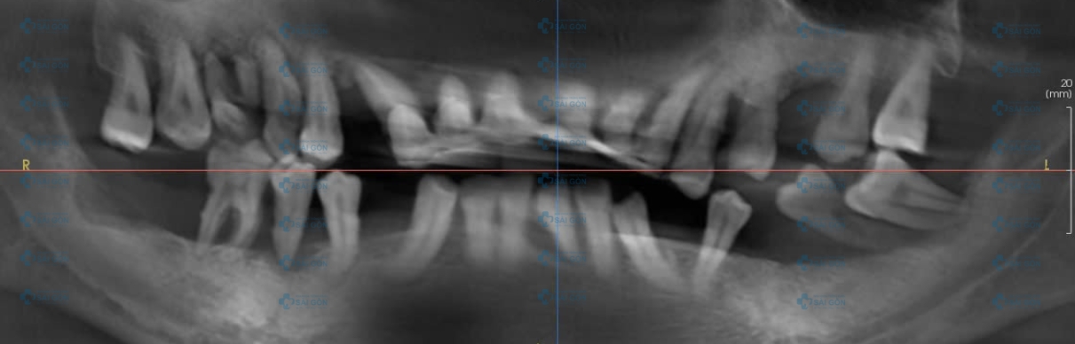 Phim chụp răng chị Lê Thị Ngọc Ánh - trồng răng implant.