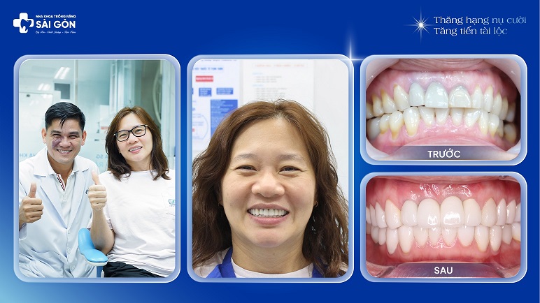 chi phan thi bao tran viet kieu my dan su veneer ket hop trong rang implant