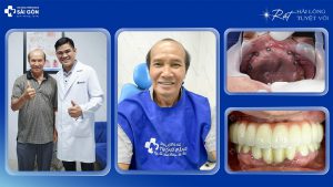 Chú Đào 67 Tuổi Ăn Ngon, Ngủ Ngon Sau Khi Trồng Răng Implant All On 6