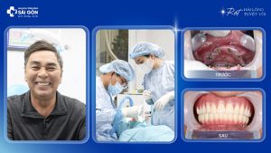 Chú Nguyễn Văn Hóa (Ninh Thuận) Trồng Răng Implant All On 4 Hai Hàm