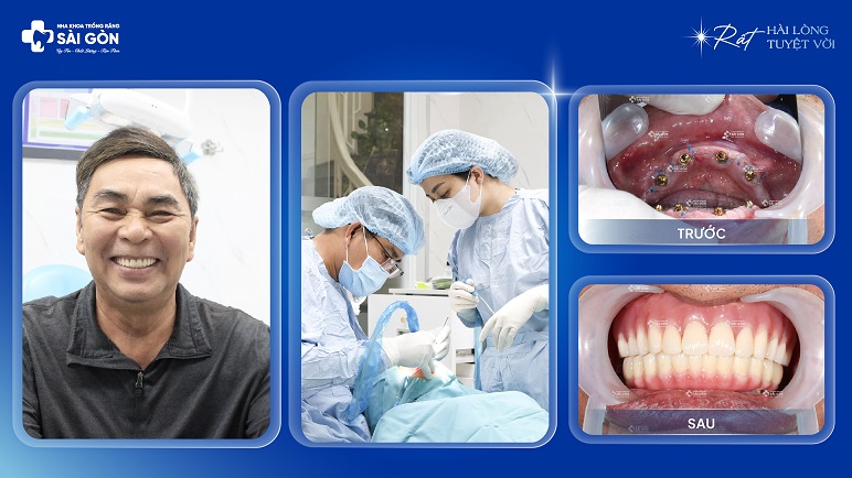 Chú Nguyễn Văn Hóa (Ninh Thuận) Trồng Răng Implant All On 4 Hai Hàm