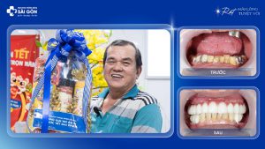 Chú Tsan Hương Quyền trẻ lại nhiều tuổi sau khi trồng răng implant toàn hàm
