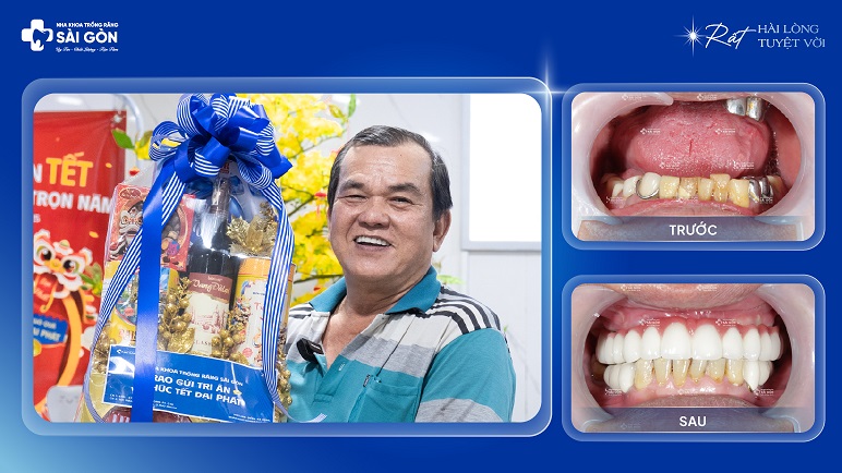 Chú Tsan Hương Quyền trẻ lại nhiều tuổi sau khi trồng răng implant toàn hàm