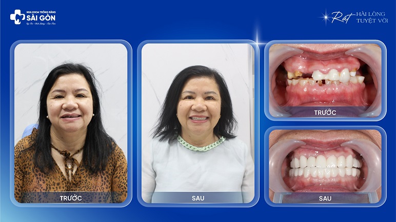 Cô Nguyễn Thị Bông Việt Kiều Canada Trồng Răng Implant Toàn Hàm