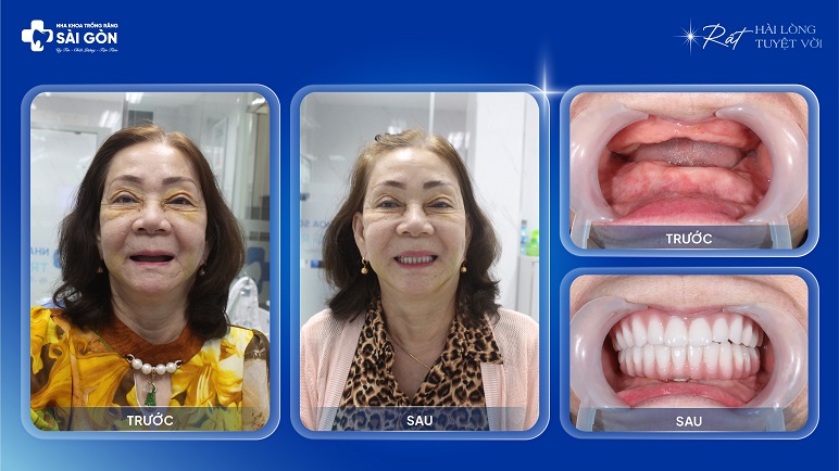 Cô Nguyễn Thị Dung (67 tuổi, Bình Thuận) Trồng Răng Implant All On 5 (Neodent, Thụy Sĩ)