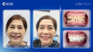 Cô Trần Thị Bích Huyền Trồng 4 Răng Implant Neodent Thụy Sĩ và Bọc Răng Sứ Thẩm Mỹ Lava Hai Hàm