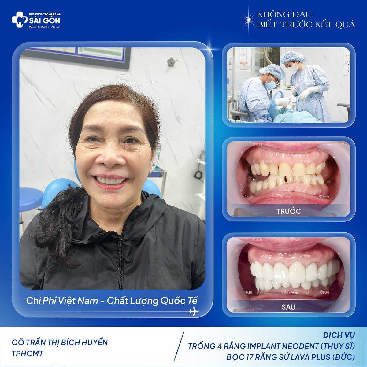 Cô Trần Thị Bích Huyền Trồng 4 Răng Implant Neodent Thụy Sĩ và Bọc Răng Sứ Thẩm Mỹ Lava Hai Hàm