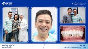 anh lam tri hong viet kieu my ve nuoc trong rang implant all on 6