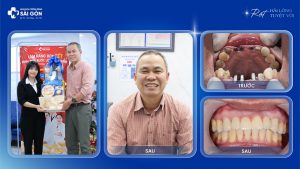anh vo thanh trung trong 4 rang implant superline