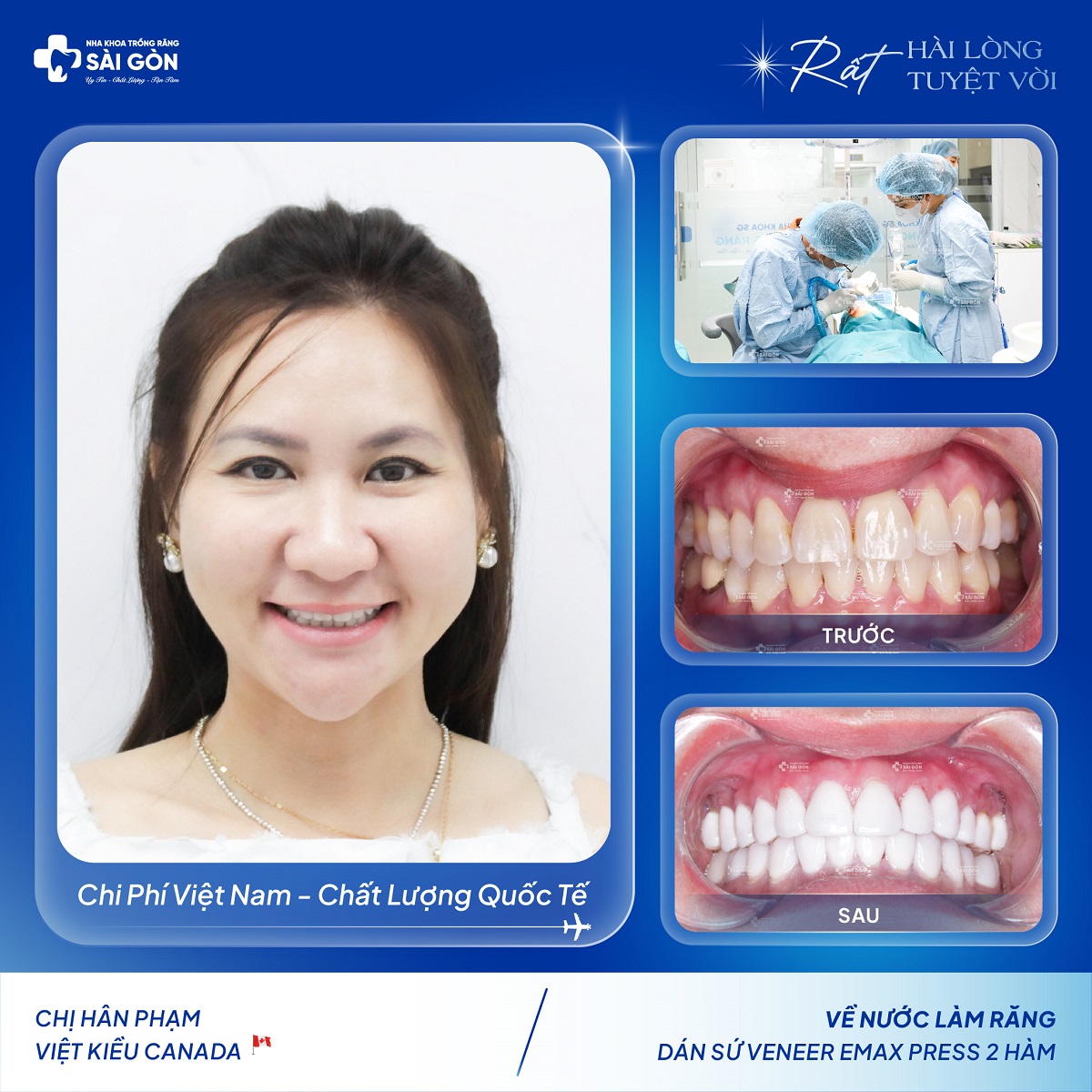 Chị Hân Phạm - Dán Sứ Veneer Emax 2 Hàm