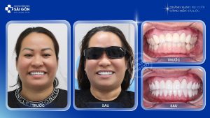 Chị Trần Nguyệt Hồng Việt Kiều Mỹ Bọc 24 Răng Sứ Zolid Đức Cao Cấp