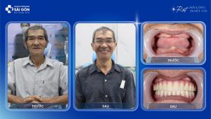 chu bui thanh dung trong rang implant toan ham
