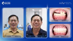 chu dang khoi trong rang implant all on 7 dentium