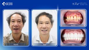 chu tran thanh nam trong rang implant khoi phuc rang mat vi viem nha chu