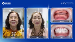 co nguyen thi dung trong rang implant all on 5 neodent