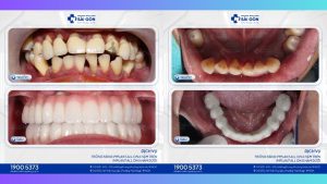 hanh trinh trong rang implant cua chi le thi ngoc anh