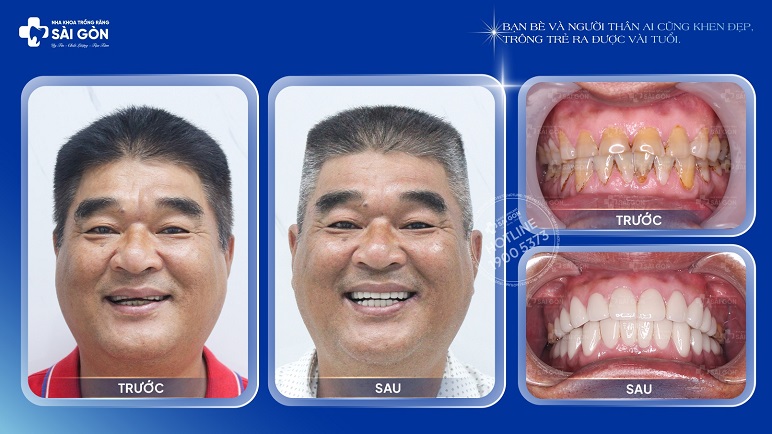 Lê Đức Khiêm Bọc 24 Răng Sứ Đức Cao Cấp