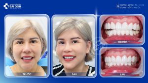 Chị Tina Phương Trần Việt Kiều Mỹ Bọc Răng Sứ Đức Hai Hàm