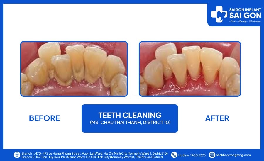 Ms Chau Thai Thanh district 10 teeth cleaning