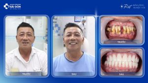 chu le long viet kieu my trong rang implant nha khoa sai gon
