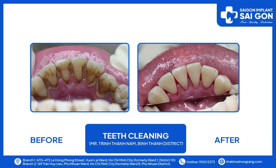 Mr Trinh Thanh Nam, Binh Thanh district - Teeth cleaning