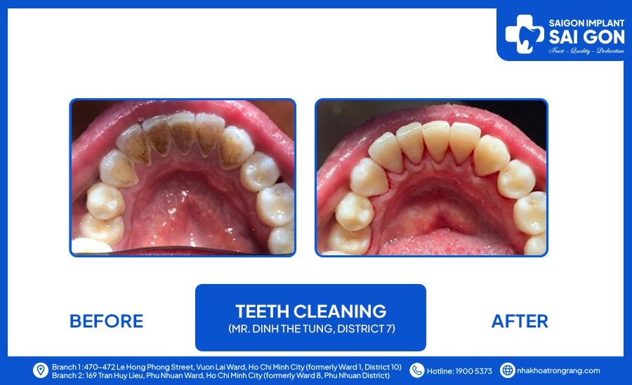 Teeth cleaning Mr. Dinh The Tung, district 7