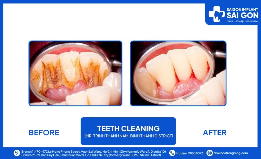 Teeth cleaning Mr Trinh Thanh Nam, Binh Thanh district