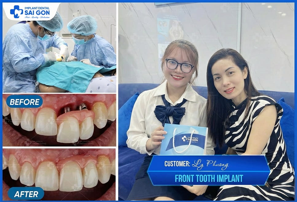 Structure of implant tooth; Dental Implant The only method capable of restoring both the tooth cronw and root