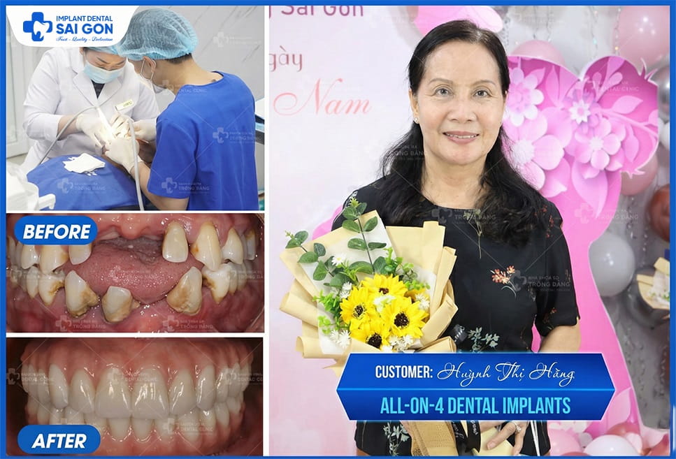 Dental Implant - Customer Huynh Thi Hang All-On-4 Dental Implants