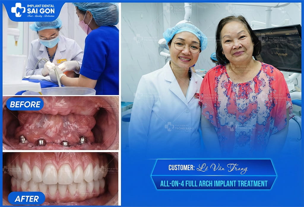 Customer Le Van Trang All-On-4 Full Arch Implant Treatment