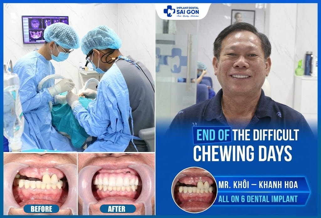 End of the difficult chewing days - Mr.Khoi All-On-6 Dental Implant