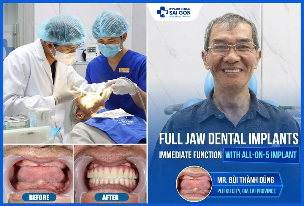 Full Jaw Dental Implants Immediate Function With All-On-5 Implant